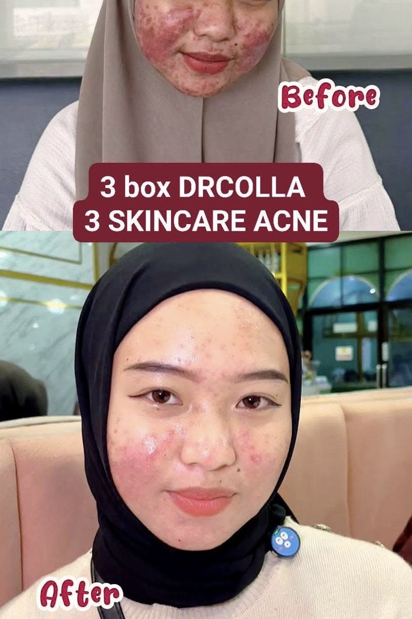 Dokumentasi pelanggan DRCOLLA dan skincare Acne